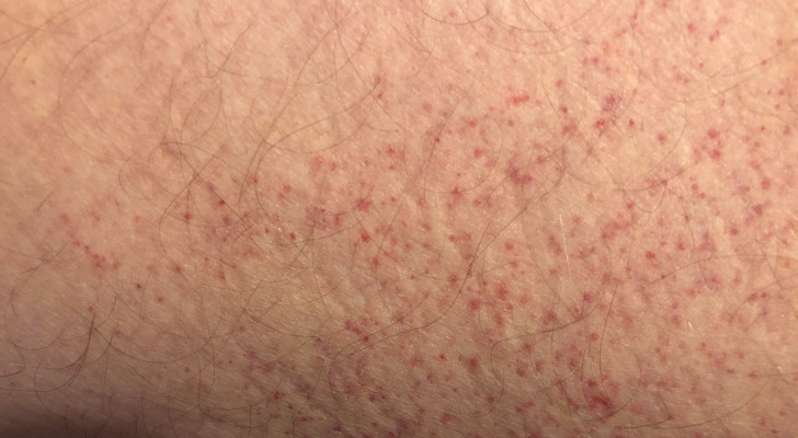 5 أعراض نعتقد أنها طبيعية لكنها قد تشير إلى لوكيميا الدم