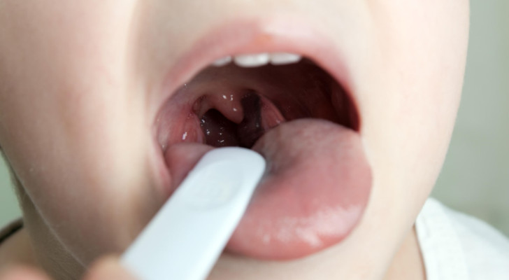 أعراض وعلامات واضحة تشير إلى ضرورة إزالة اللوزتين عند طفلك