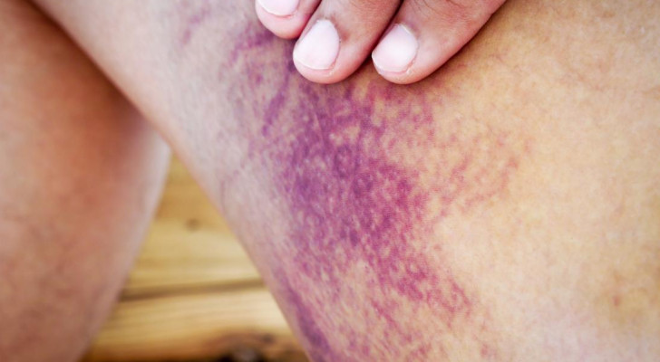 ما هي علامات وأعراض النزيف الداخلي؟