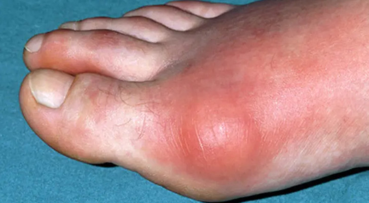 ما أفضل علاج للنقرس؟ دليل شامل لعلاج النقرس والوقاية من مضاعفاته