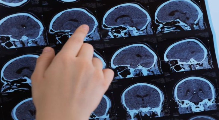 ما هي أعراض التصلب اللويحي؟ وعلى أي عمر تبدأ الأعراض بالظهور؟