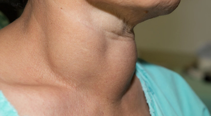 أفضل علاج لتضخم الغدة الدرقية.. متى تكفي الأدوية ومتى يلزم التدخل الجراحي؟