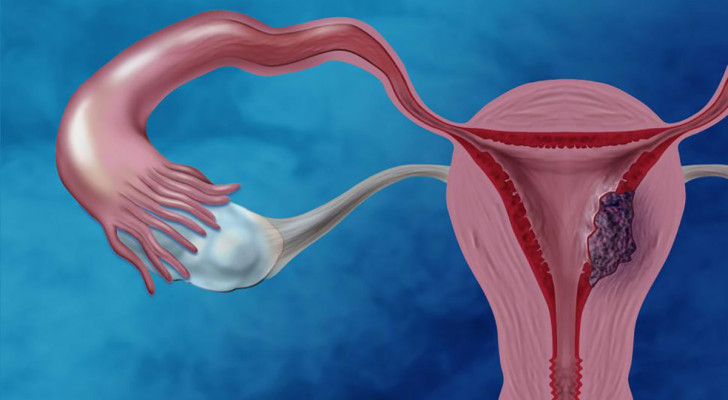 أول أعراض سرطان الرحم عند النساء: علامات لا تتجاهليها