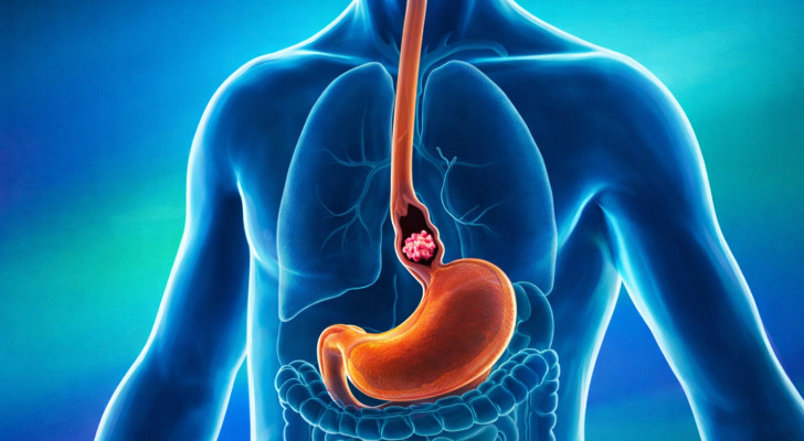 كيف نكشف سرطان المعدة والمريء مبكرا؟ علامات وأعراض لا يجب تجاهلها