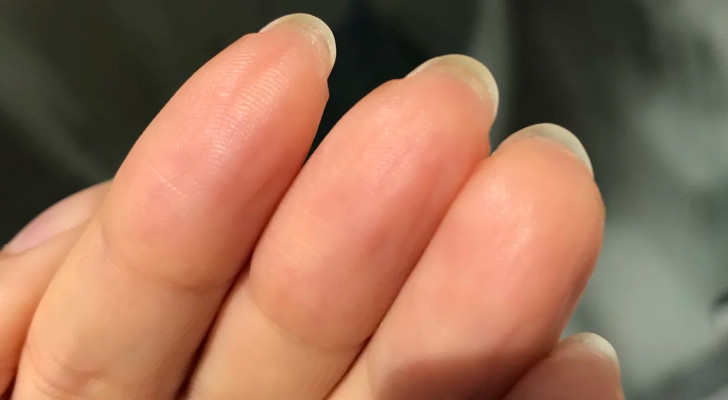 انتبه لأظافرك!… "السرطان" قد يكون مختبئا تحتها