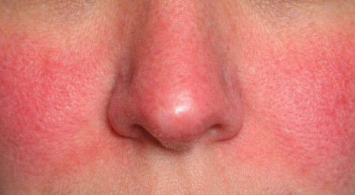 احمرار الوجه المستمر عند النساء بعد سن الثلاثين.. دليل على الصحة أم علامة مرضية؟