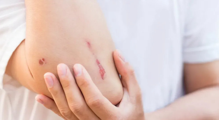 لماذا لا يلتئم الجرح أو الحرق بسرعة؟ الأسباب العلمية وراء بطء الشفاء