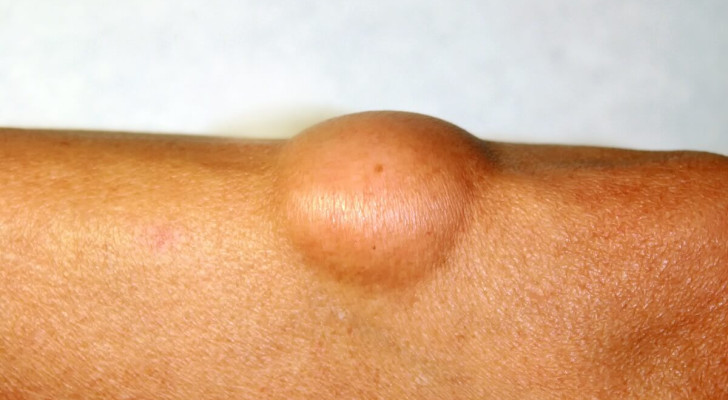 ماذا يعني وجود كتلة صلبة ثابتة تحت الجلد؟ ومتى يتطلب الأمر فحص طبي؟