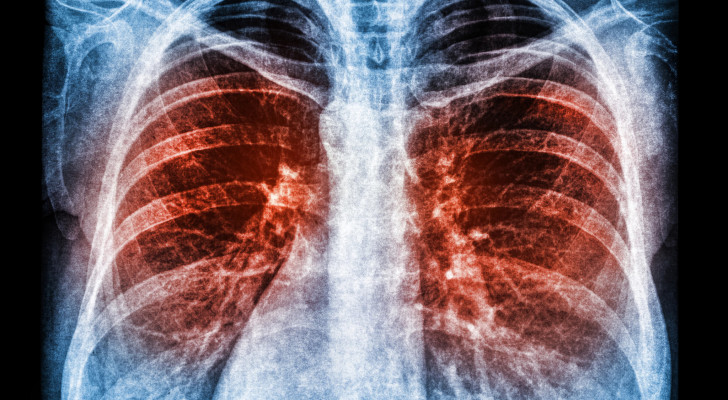 هل تعاني من التهابات متكررة في الصدر في الآونة الأخيرة؟ إليك أهم المعلومات