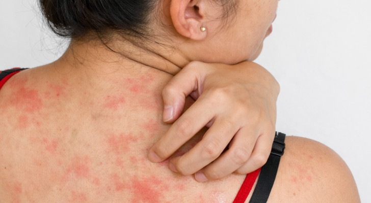 فطريات الظهر.. لماذا تظهر بعض البقع الفطرية على الظهر؟ وكيف يمكن التخلص منها وعلاجها؟