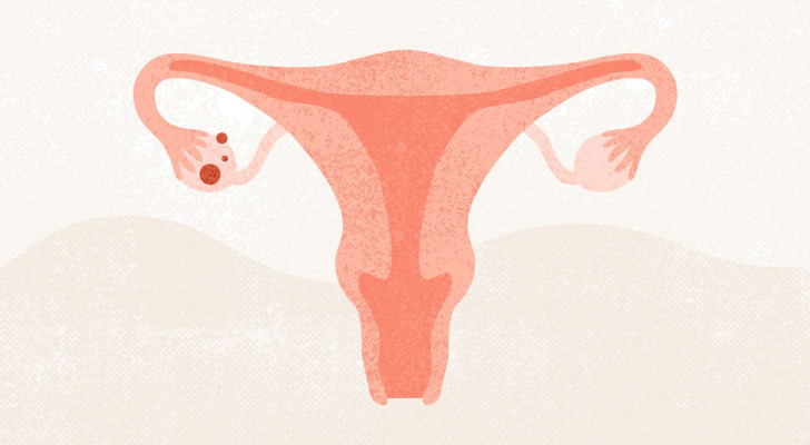 ما الفرق بين الورم الخبيث على المبيض والكيس الكبير على المبيض من حيث الأعراض؟