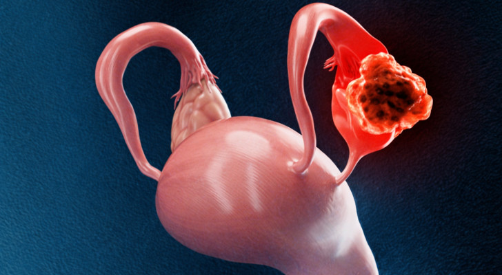 هل يمكن علاج سرطان المبيض من الدرجة الأولى بدون استئصال الرحم والمبايض؟ وما نسبة الشفاء؟