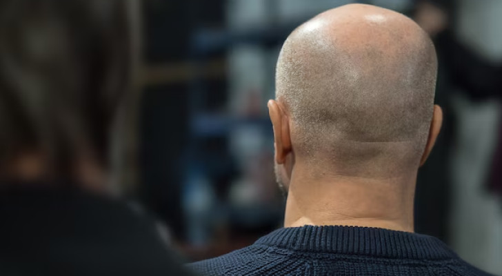 إسبانيا وإيطاليا وفرنسا.. الدول الثلاث الأكثر إصابة بالصلع عالميا.. ما السر؟