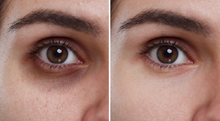وصفة كريم منزلي يزيل الهالات السوداء والتجويف تحت العين خلال أسبوعين.. يسمى بديل الفيلر!
