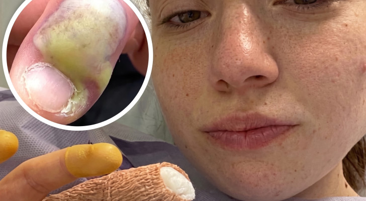 كادت تفقد إصبعها.. إصابة شابة بعدوى بكتيرية خطيرة بسبب قضم الأظافر