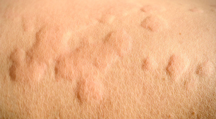 طفح السباح وحساسية الكلور.. لماذا تظهر الحكة بعد البحر والمسابح؟