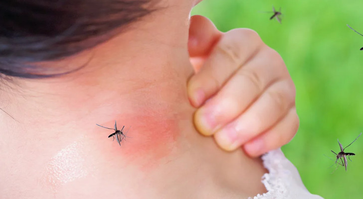 لماذا يوصي الأطباء بتجنب حك لدغات البعوض؟