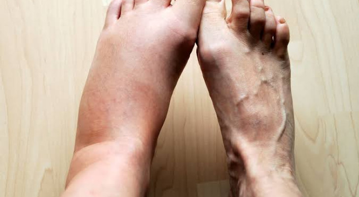 ما أعراض انسداد شرايين القدم أو الساق؟ علامات لا يجب تجاهلها