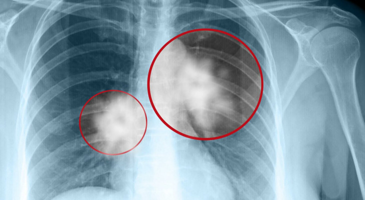 ماذا يحدث للجسم في المرحلة الـ4 من السرطان؟ علامات تكشف وصول المرض لمراحل متقدمة