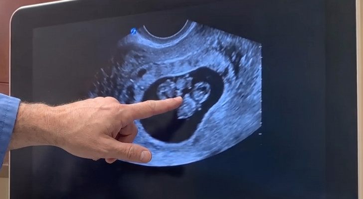 أعراض الحمل بتوأم.. إشارات قد يلاحظها جسمك مبكرا