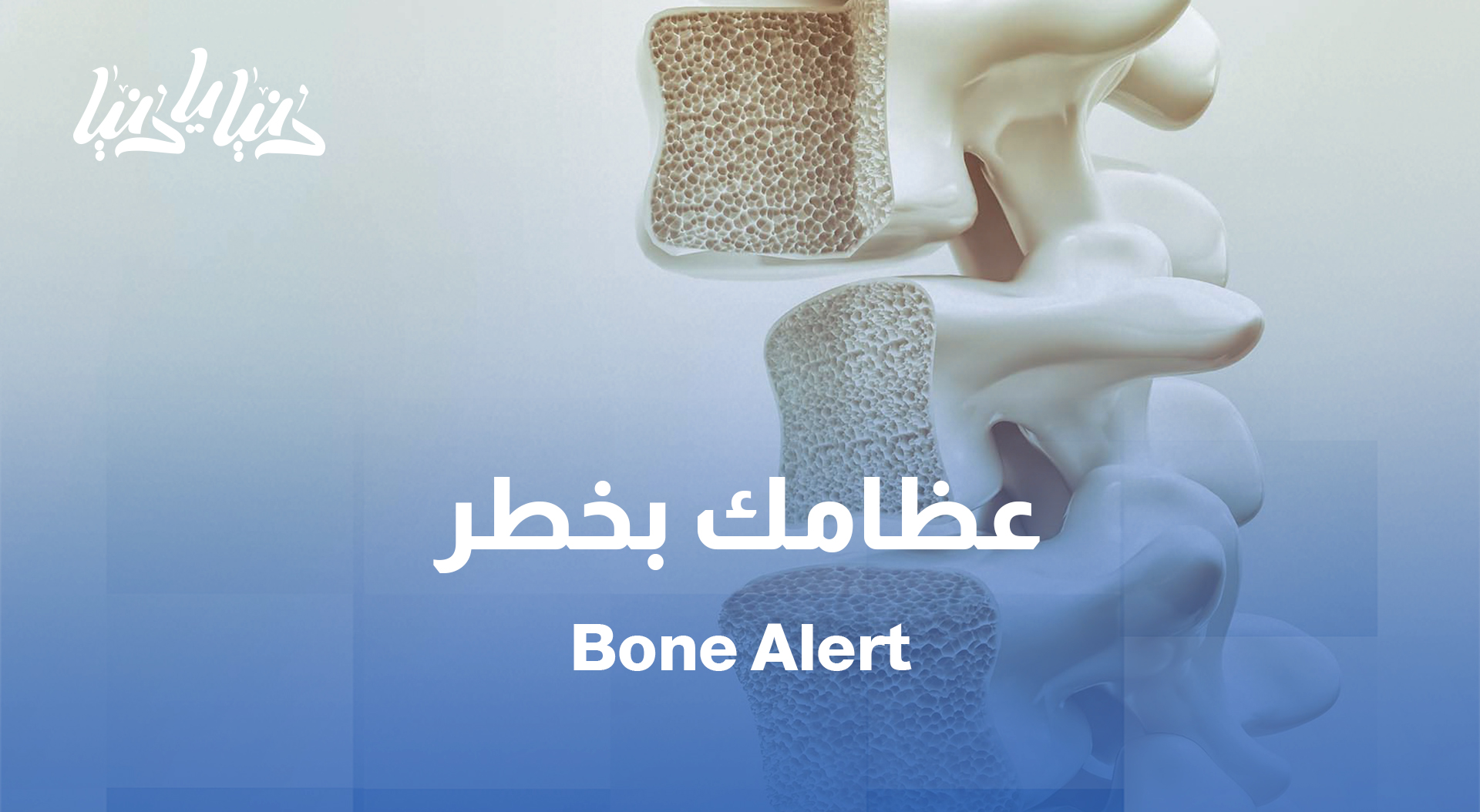 هشاشة العظام… المرض الصامت! فكيف نكتشفه قبل فوات الأوان؟