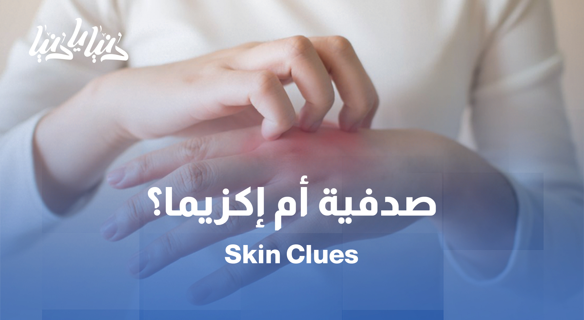 كيف نميّز الصدفية عن الإكزيما؟