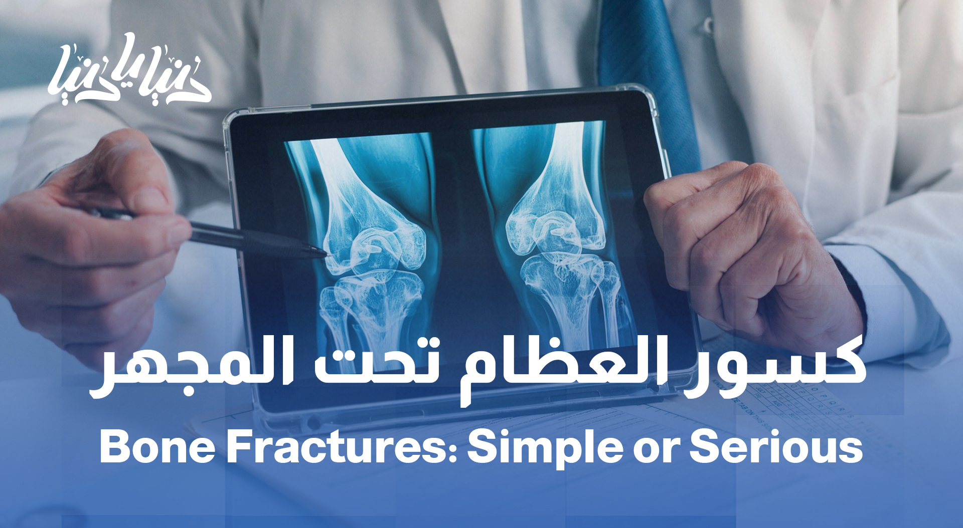 كسور بسيطة؟ ولا خطر كبير؟ الجواب عند طبيب العظام