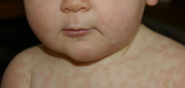 الأمراض الجلدية الفيروسية لدى الأطفال - فيديو