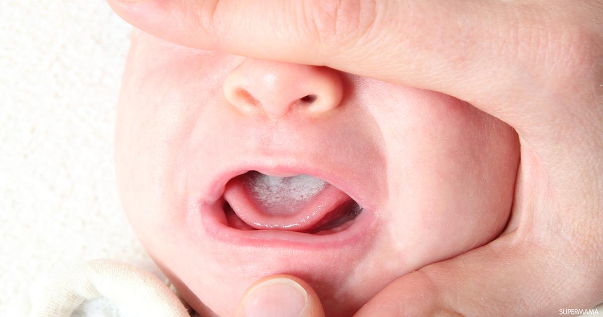 أسباب فطريات الفم للرضع