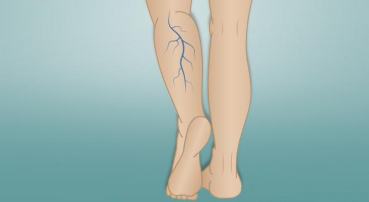 استشاري جراحة: 1 من بين 3 أشخاص معرضون للإصابة بدوالي الساق - فيديو