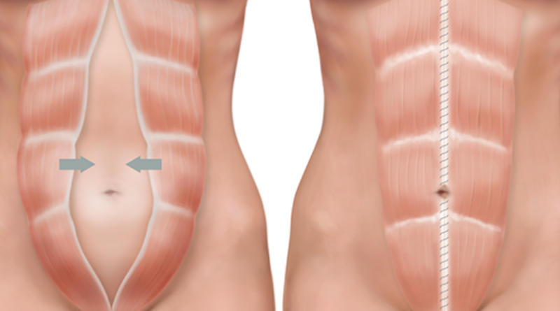 ما هو الإنفصال العضلي.. وكيف يعالج؟ - فيديو