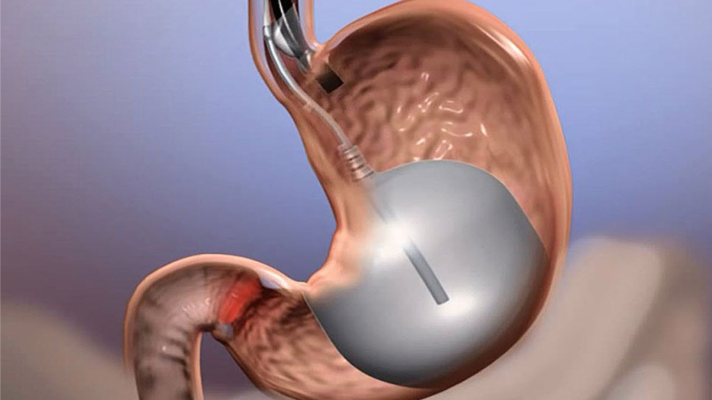 تقنية بالون المعدة" وعلاقتها بخسارة الوزن.. والشروط الواجب توافرها لإجراءها" - فيديو