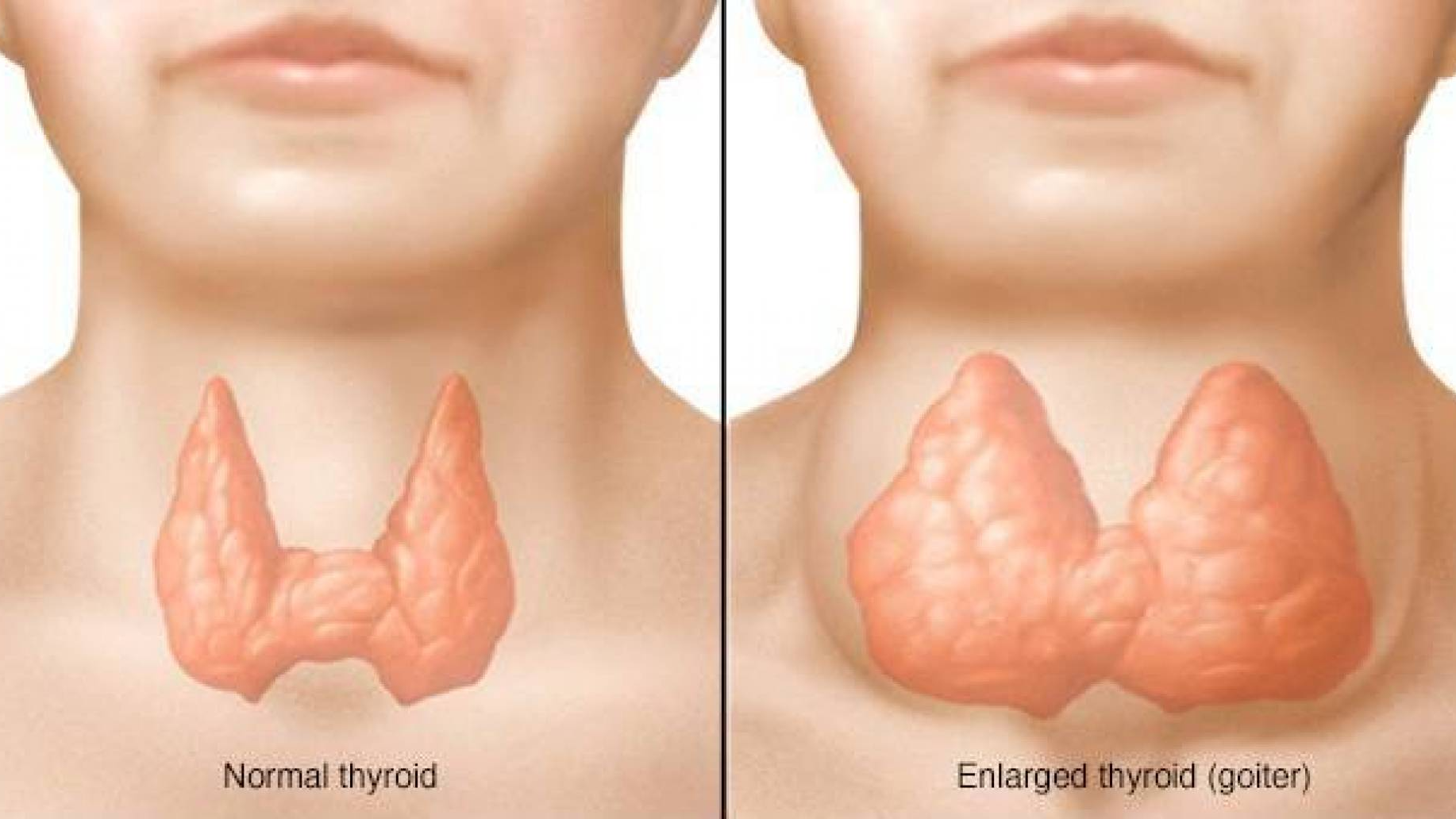 إنتفاخ الغُدة الدرقية لا يعني الإصابة بالسرطان - فيديو