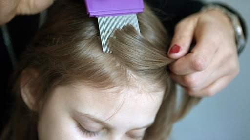 طُرق طبيعية منزلية فعالة للتخلُص من قمل الشعر لدى الأطفال - فيديو